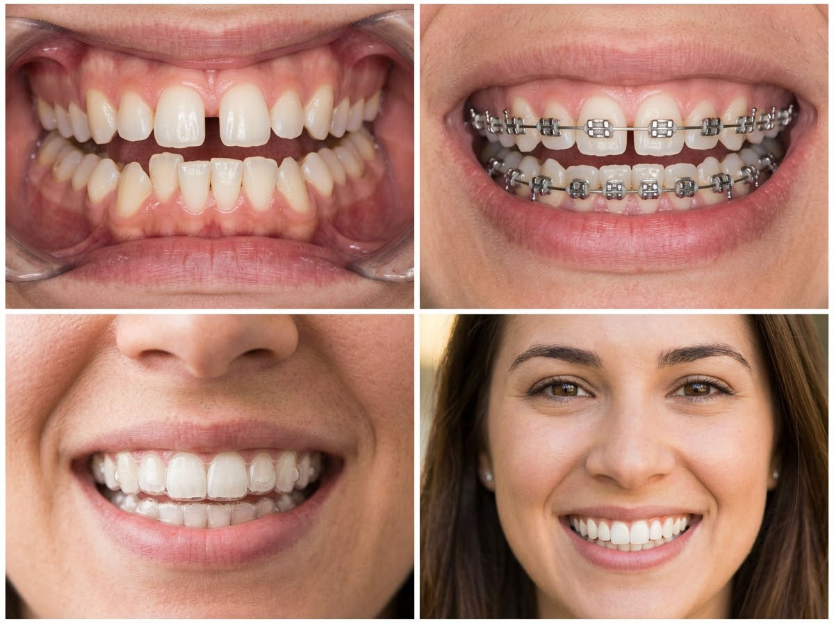 Correction of crooked teeth, gaps and crowding