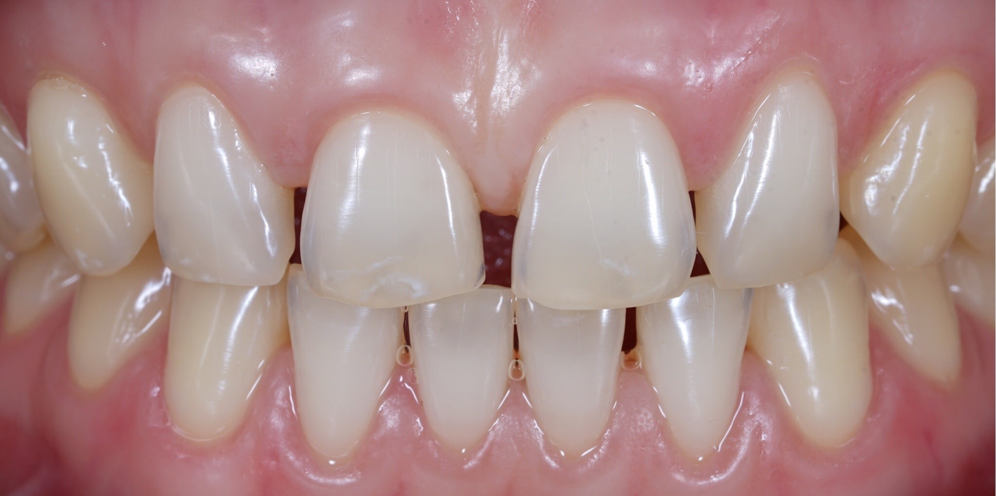 Closed gaps after clear aligner treatment