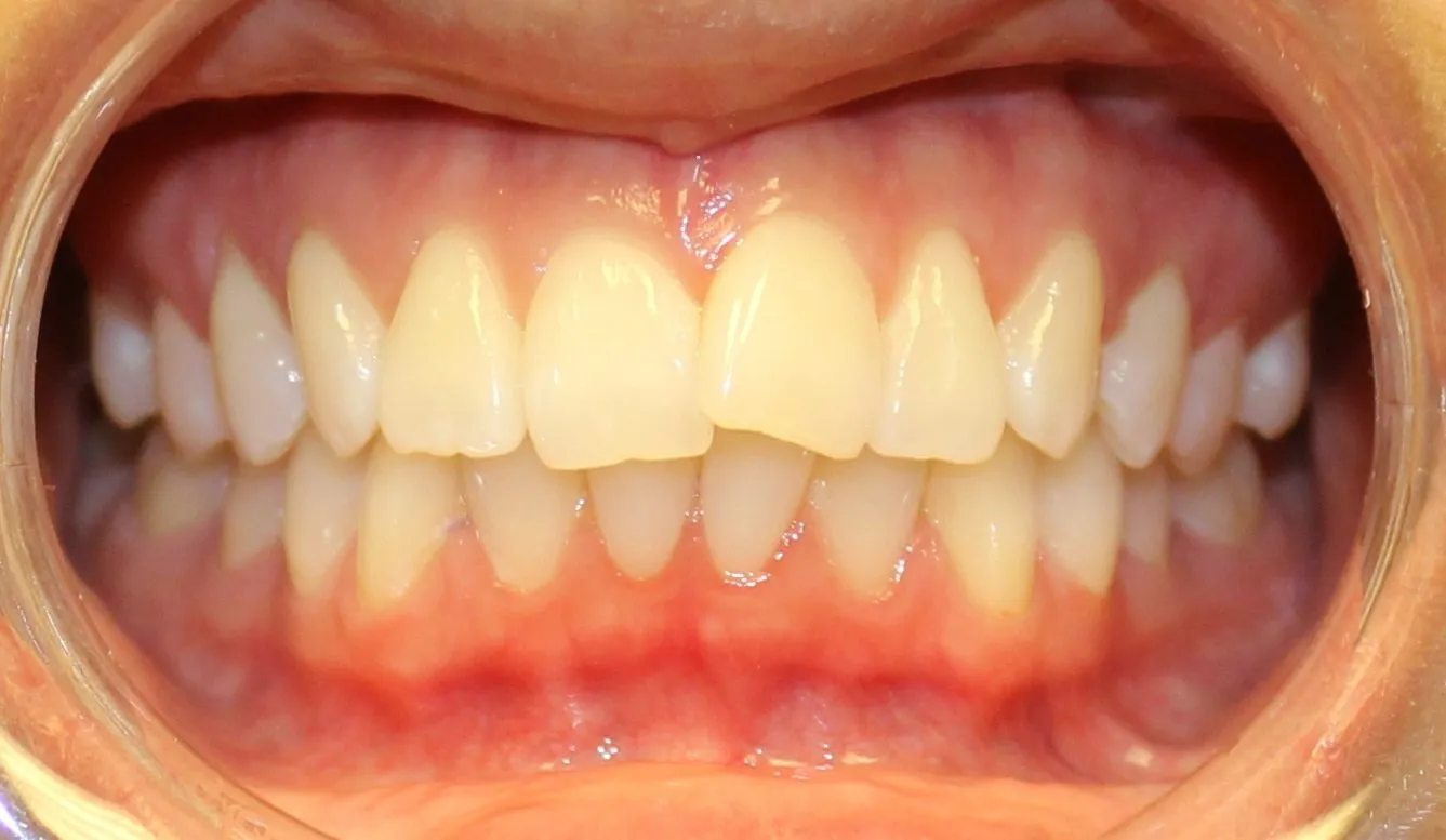 Aligned upper teeth after braces treatment