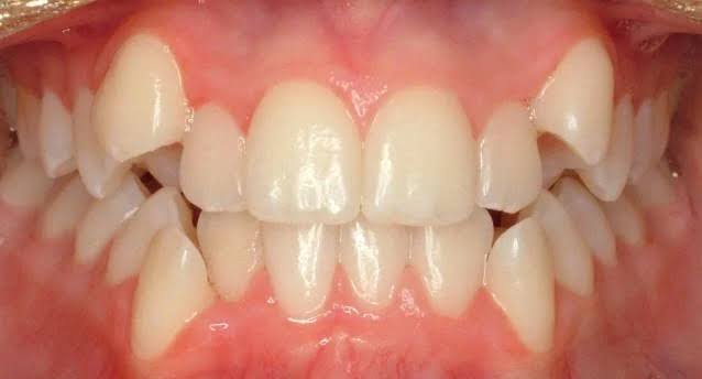 Crowded upper teeth before braces treatment