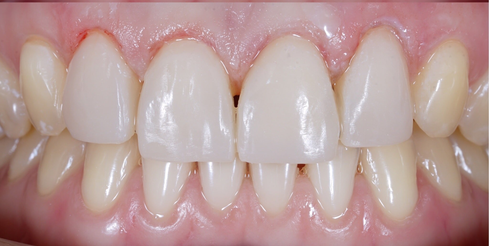 Gaps between front teeth before treatment