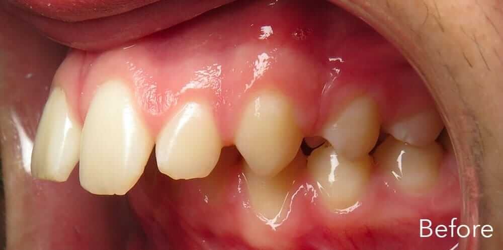 Protruding front teeth before orthodontic treatment