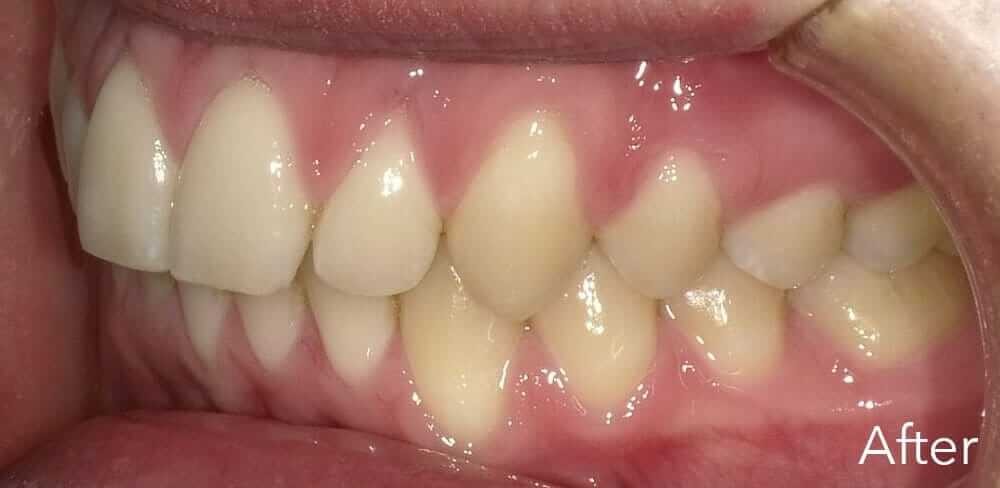 Corrected bite after orthodontic treatment
