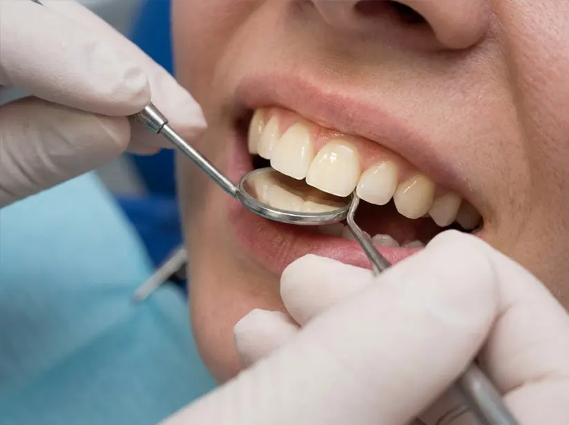 Anterior esthetic restoration of children's front teeth